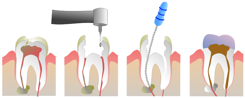 Endodontia Maringá